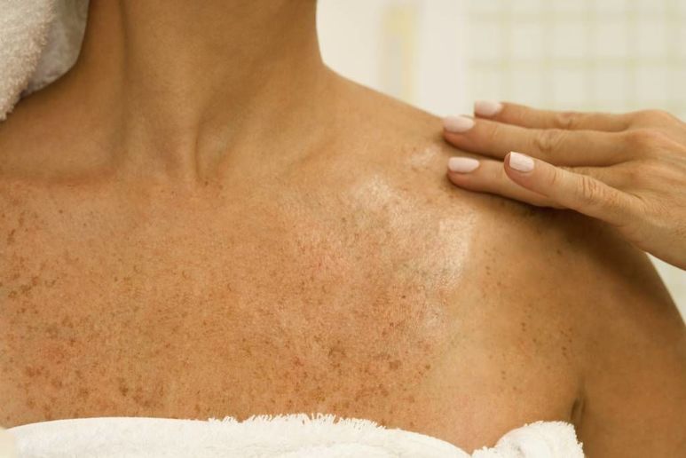 Появление пигментации на коже после загара - Полезные статьи Клиники Гуру