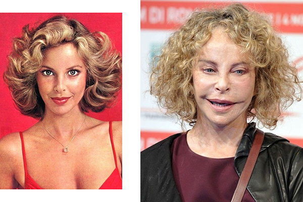 Plastic surgery before and after - 9 celebrities on what it's really like